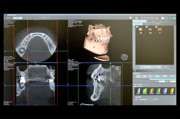 歯科用ＣＴ